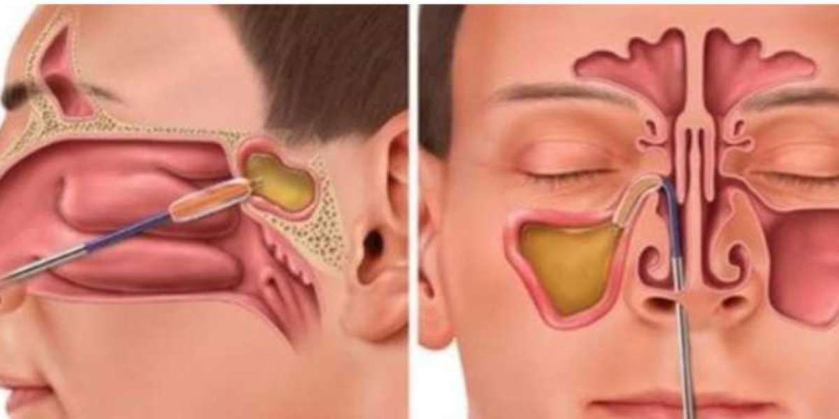 Balloon Sinuplasty: A Minimally Invasive Option for Chronic Sinusitis