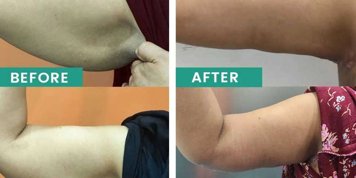 Best Liposuction in Lahore: Achieve Your Dream Body with Cosmeticoplasty